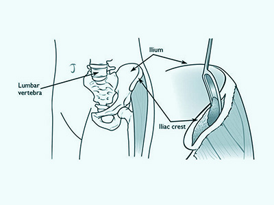 Bone Graft